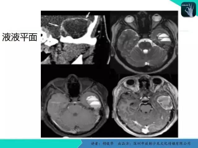 【PPT】颅面骨巨细胞修复性肉芽肿的影像诊断