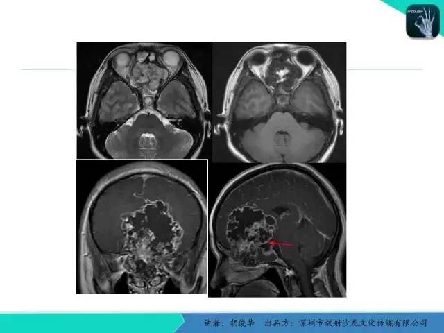 【PPT】颅面骨巨细胞修复性肉芽肿的影像诊断