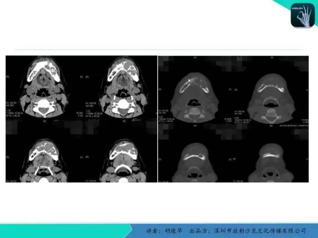 【PPT】颅面骨巨细胞修复性肉芽肿的影像诊断