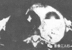 “双弓征” 的影像表现与临床意义