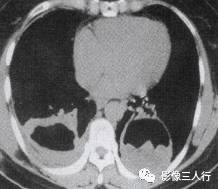 “双弓征” 的影像表现与临床意义
