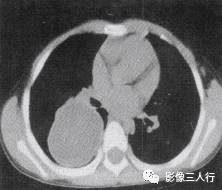 “双弓征” 的影像表现与临床意义