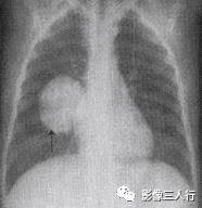 “双弓征” 的影像表现与临床意义
