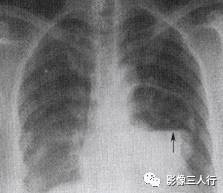 “双弓征” 的影像表现与临床意义