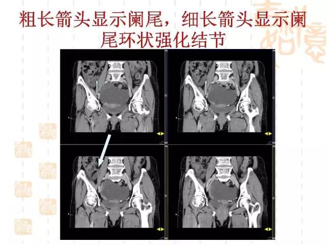 【病例】阑尾粘液性肿瘤2例影像诊断与鉴别