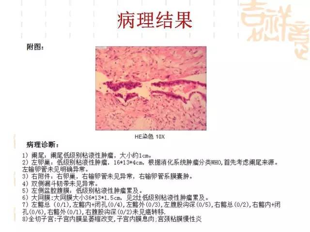 【病例】阑尾粘液性肿瘤2例影像诊断与鉴别