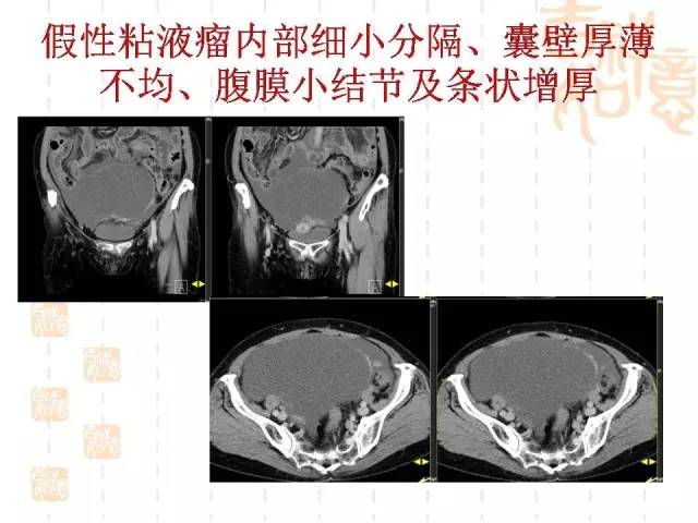 【病例】阑尾粘液性肿瘤2例影像诊断与鉴别