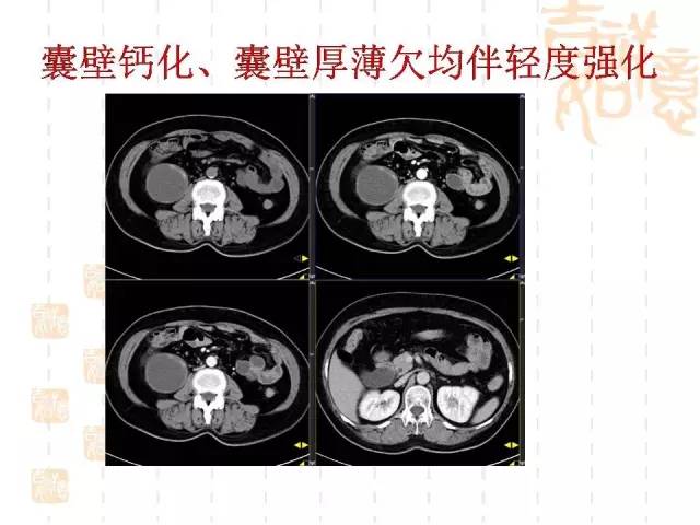 【病例】阑尾粘液性肿瘤2例影像诊断与鉴别