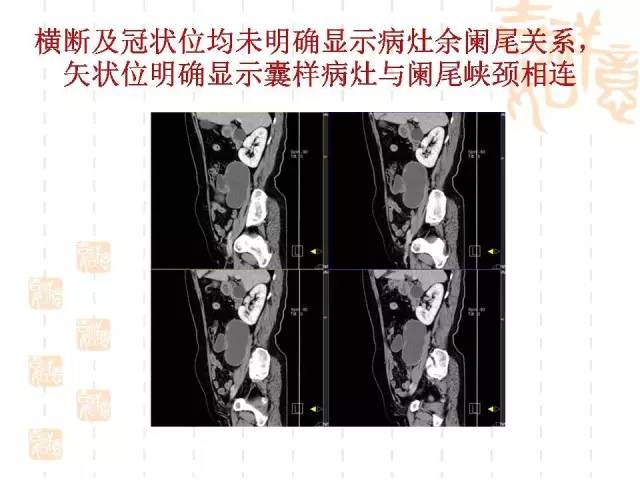 【病例】阑尾粘液性肿瘤2例影像诊断与鉴别