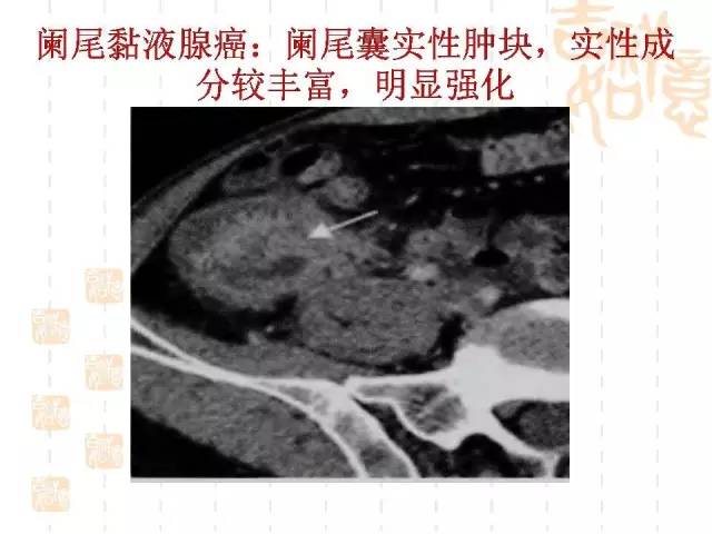 【病例】阑尾粘液性肿瘤2例影像诊断与鉴别