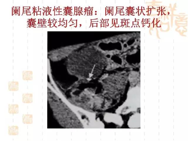 【病例】阑尾粘液性肿瘤2例影像诊断与鉴别