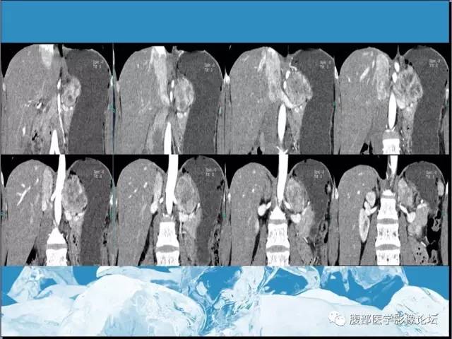 【病例】腹膜后副神经节瘤1例CT影像表现 【病例】腹膜后副神经节瘤1例CT影像表现