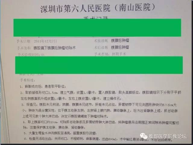 【病例】腹膜后副神经节瘤1例CT影像表现 【病例】腹膜后副神经节瘤1例CT影像表现