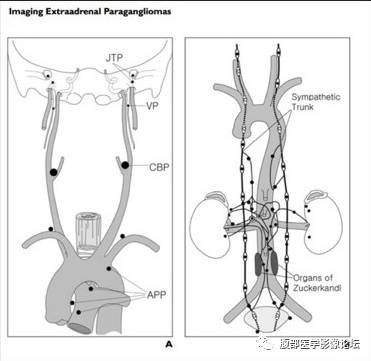 【病例】腹膜后副神经节瘤1例CT影像表现 【病例】腹膜后副神经节瘤1例CT影像表现