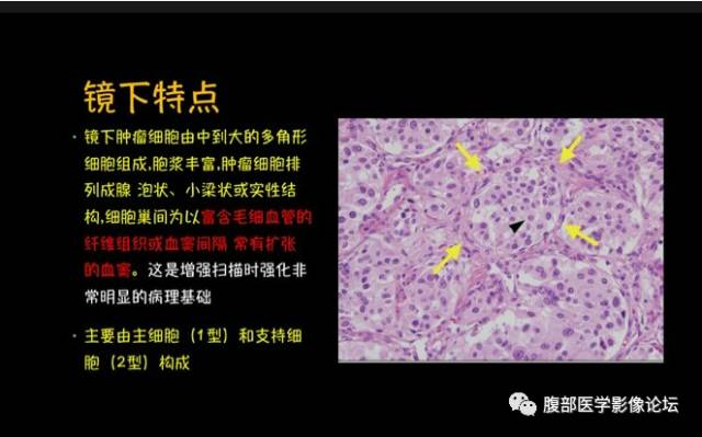 【病例】腹膜后副神经节瘤1例CT影像表现 【病例】腹膜后副神经节瘤1例CT影像表现