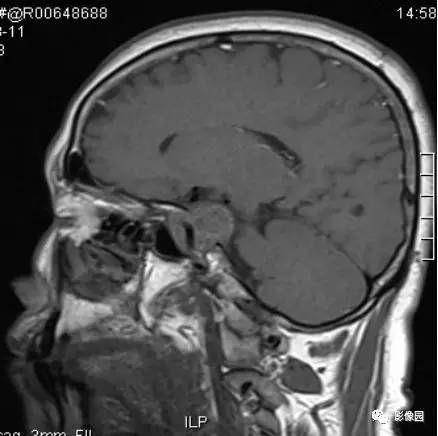 【病例】海绵窦海绵状血管瘤1例MR影像讨论 【病例】海绵窦海绵状血管瘤1例MR影像讨论