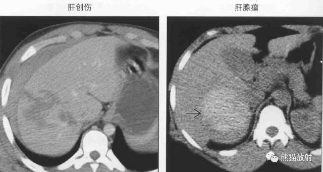 【书摘】“伴有出血的局部肝损害”之鉴别诊断
