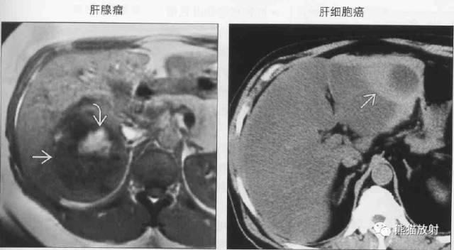 【书摘】“伴有出血的局部肝损害”之鉴别诊断