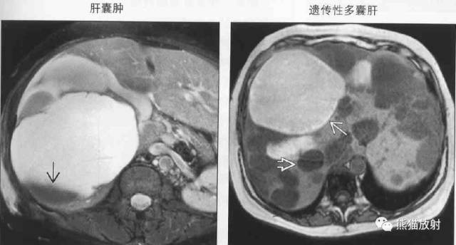 【书摘】“伴有出血的局部肝损害”之鉴别诊断