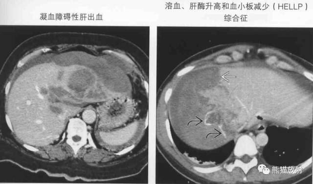 【书摘】“伴有出血的局部肝损害”之鉴别诊断
