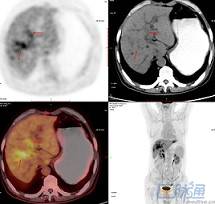PET-CT在胆管癌中的应用 PET-CT在胆管癌中的应用