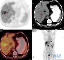 PET-CT在胆管癌中的应用
