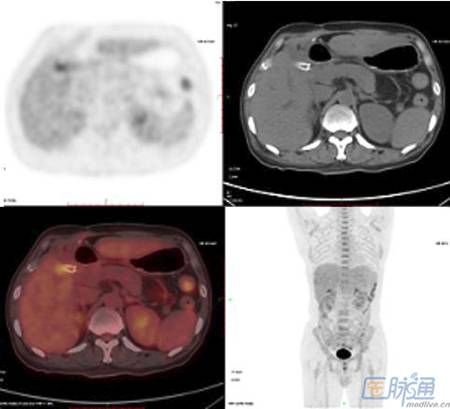 PET-CT在胆管癌中的应用 PET-CT在胆管癌中的应用