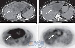 PET-CT在胆管癌中的应用 PET-CT在胆管癌中的应用