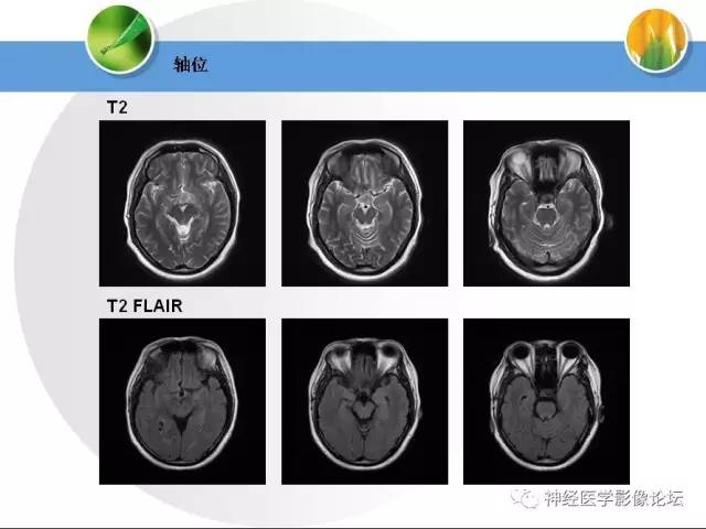 【病例】CNS窦淋巴组织细胞增生伴巨淋巴结病1例MR 【病例】CNS窦淋巴组织细胞增生伴巨淋巴结病1例MR