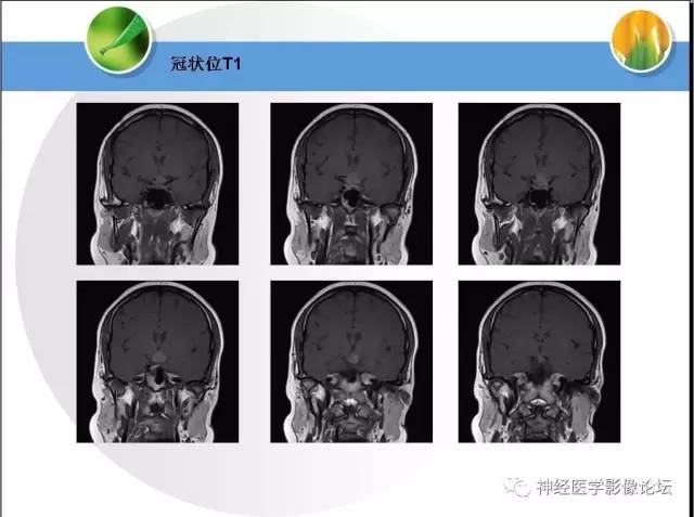 【病例】CNS窦淋巴组织细胞增生伴巨淋巴结病1例MR 【病例】CNS窦淋巴组织细胞增生伴巨淋巴结病1例MR