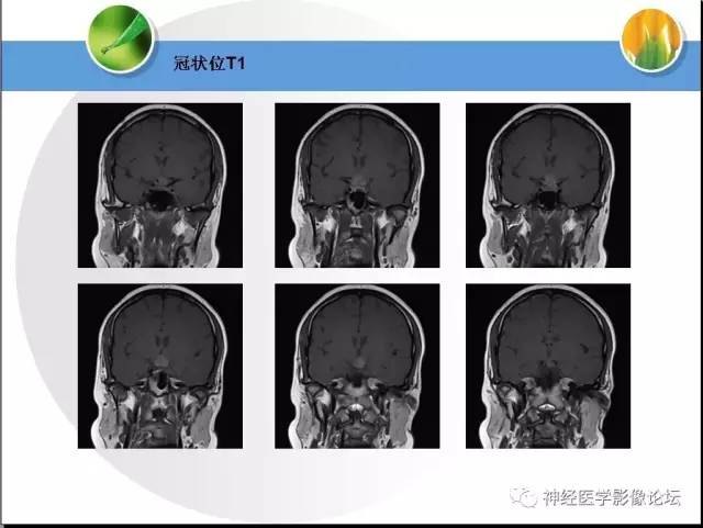 【病例】CNS窦淋巴组织细胞增生伴巨淋巴结病1例MR 【病例】CNS窦淋巴组织细胞增生伴巨淋巴结病1例MR