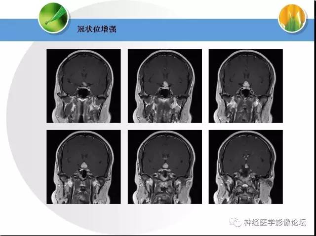 【病例】CNS窦淋巴组织细胞增生伴巨淋巴结病1例MR 【病例】CNS窦淋巴组织细胞增生伴巨淋巴结病1例MR