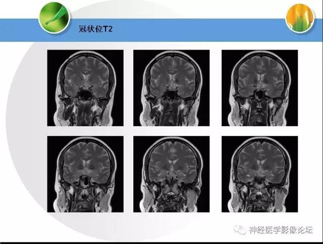 【病例】CNS窦淋巴组织细胞增生伴巨淋巴结病1例MR 【病例】CNS窦淋巴组织细胞增生伴巨淋巴结病1例MR