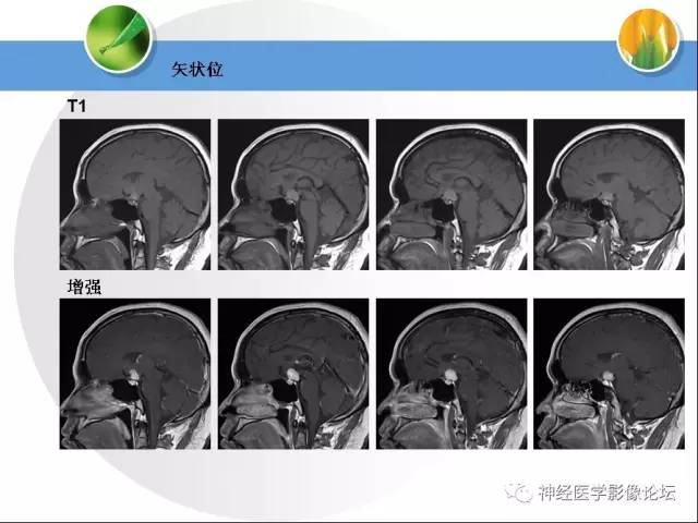 【病例】CNS窦淋巴组织细胞增生伴巨淋巴结病1例MR 【病例】CNS窦淋巴组织细胞增生伴巨淋巴结病1例MR