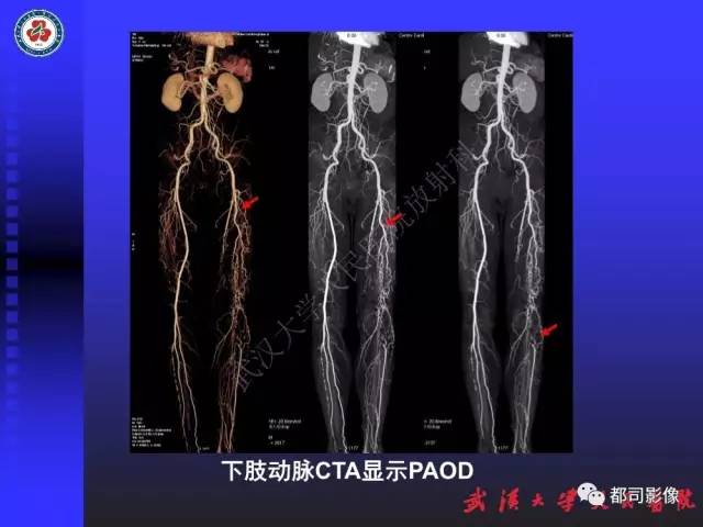 【PPT】下肢血管性病变CTA和MRA