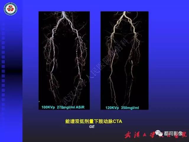 【PPT】下肢血管性病变CTA和MRA
