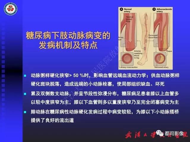 【PPT】下肢血管性病变CTA和MRA