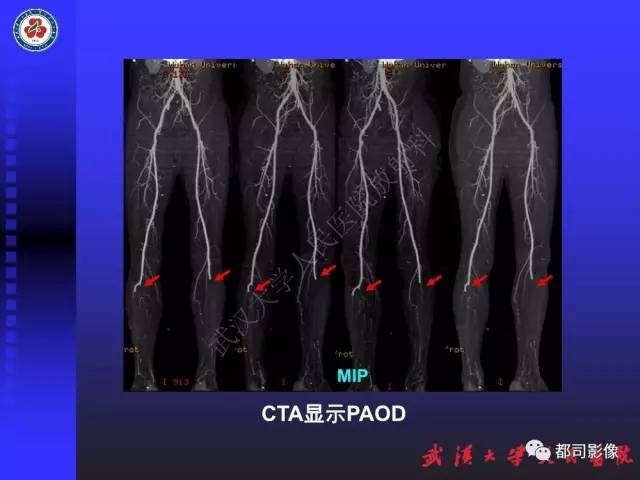 【PPT】下肢血管性病变CTA和MRA