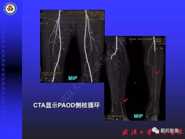 【PPT】下肢血管性病变CTA和MRA