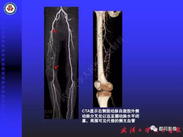 【PPT】下肢血管性病变CTA和MRA