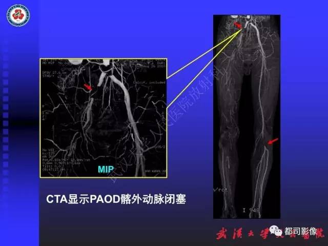 【PPT】下肢血管性病变CTA和MRA