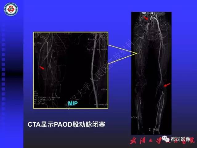 【PPT】下肢血管性病变CTA和MRA