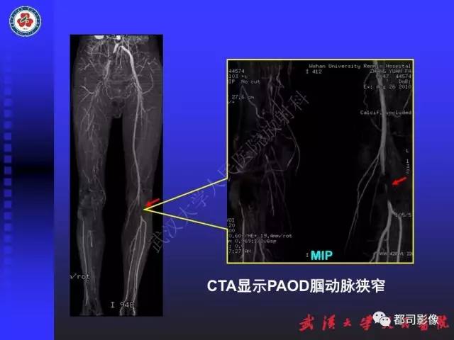 【PPT】下肢血管性病变CTA和MRA