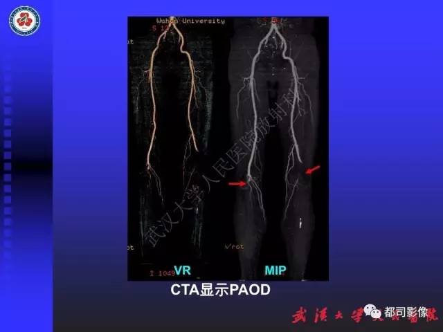 【PPT】下肢血管性病变CTA和MRA