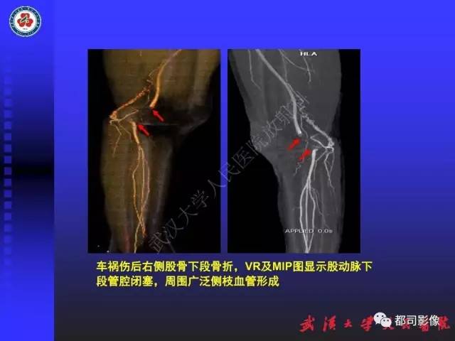 【PPT】下肢血管性病变CTA和MRA