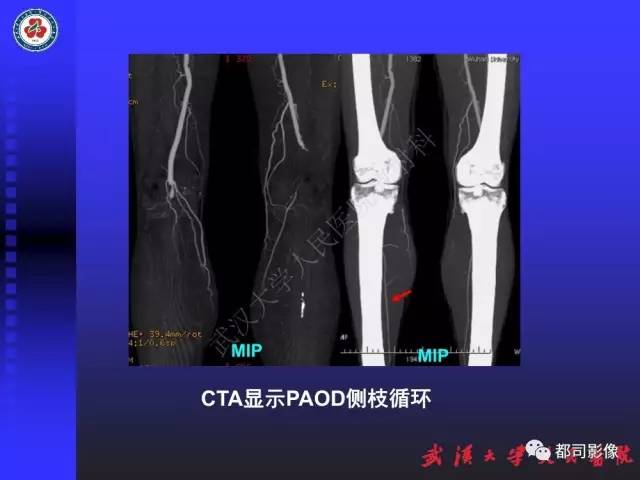 【PPT】下肢血管性病变CTA和MRA