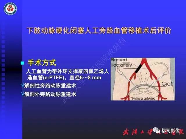 【PPT】下肢血管性病变CTA和MRA