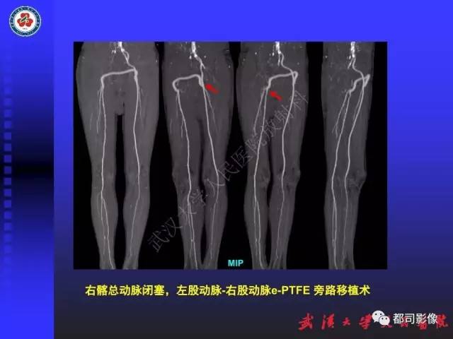 【PPT】下肢血管性病变CTA和MRA