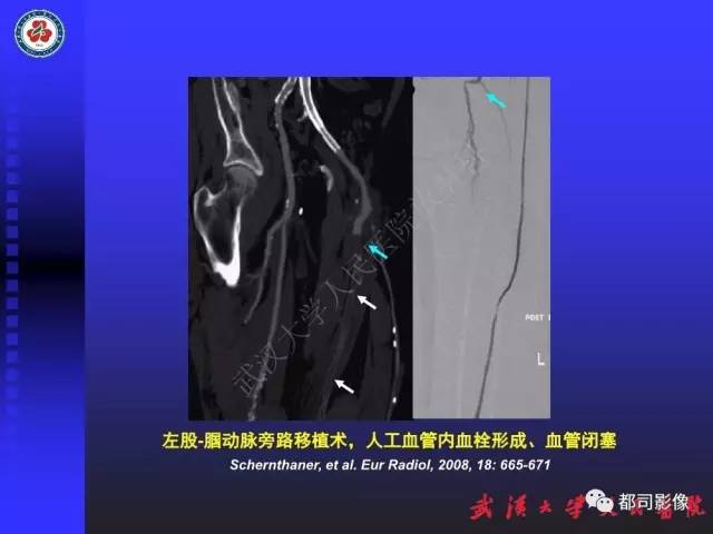 【PPT】下肢血管性病变CTA和MRA