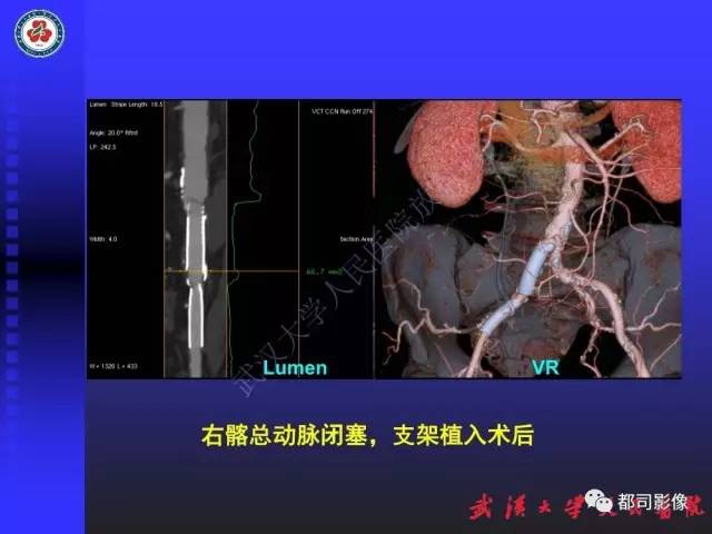 【PPT】下肢血管性病变CTA和MRA